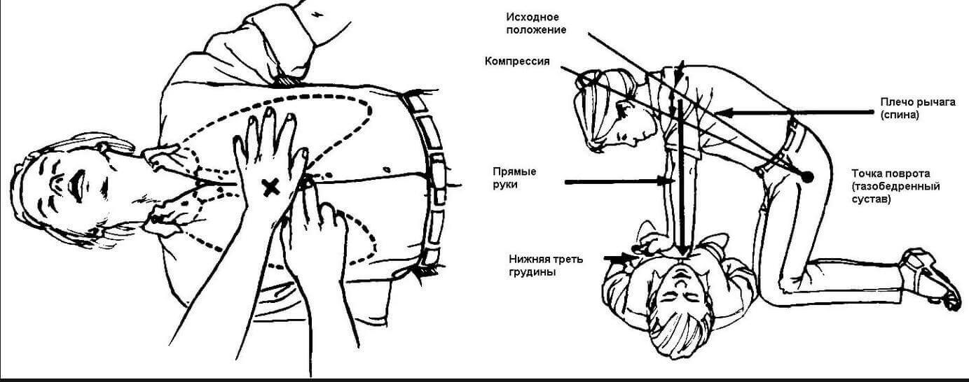 Как следует расположить руки. Схема проведения непрямого массажа сердца. Схема проведения наружного массажа сердца. Техника проведения непрямого массажа сердца. Алгоритм проведения наружного непрямого массажа сердца.