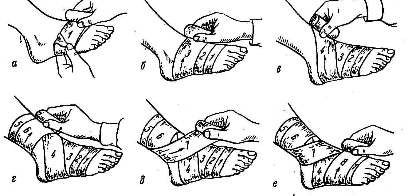 Как делать перевязку бинтом. Наложение повязки на голеностоп. Восьмиобразная повязка на голеностопный сустав алгоритм. Техника наложения восьмиобразной повязки. Повязка на голеностопный сустав восьмиобразная техника наложения.